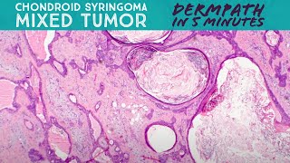 Chondroid syringoma  Mixed tumor Dermpath in 5 Minutes dermatology pathology dermatopathology [upl. by Bradlee804]