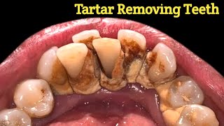 Best tartar removal Ive ever seen  tartar removing  tartar [upl. by Aray]