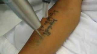 Laser Tattoo Removal Houston [upl. by Jolda]