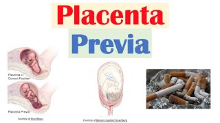 Placenta Previa Low Lying Placenta  Risk Factors Symptoms amp Complications Diagnosis Treatment [upl. by Gnuhc]