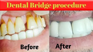 fixed dental bridge before and after [upl. by Enilec]