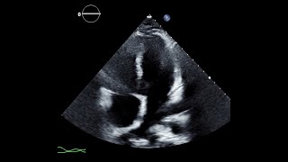 Transthoracic Echocardiogram Showing Signs of Constrictive Physiology [upl. by Emawk783]