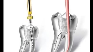 Endodontie  les étapes du traitement endodontique en détail [upl. by Ahsimal]