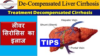 Decompensated liver cirrhosis  Decompensated liver disease [upl. by Ystap]