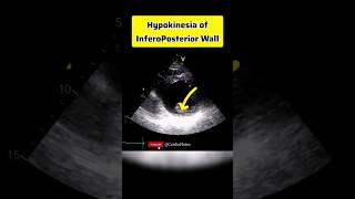 Hypokinetic InferoPosterior Wall anatomy heartphysiology heart echocardiagram [upl. by Annyl]