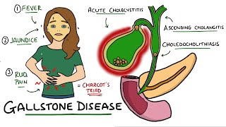 Gallstone Disease  Acute Cholecystitis vs Cholelithiasis vs Choledocholithiasis vs Cholangitis [upl. by Meakem353]