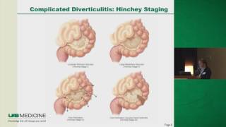 Diverticulitis To Operate or Not [upl. by Neeuq712]