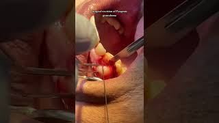 Surgical excision of Pyogenic Granuloma [upl. by Ledairam]