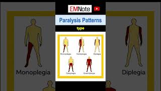 Paralysis or Weakness Patterns [upl. by Aan]