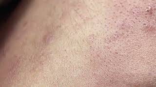 Acne on skin  Remove nose pimples  Acne Treatments Mai Ngoc 💕💕💕 [upl. by Adeuga]