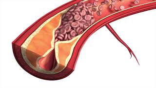 Dr Miloš Sladojević  Karotidna arterija [upl. by Fernandez530]