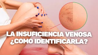 Como Identificar La Insuficiencia Venosa [upl. by Deanna]