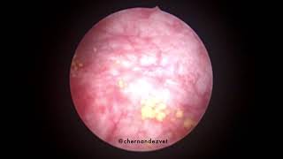 Cystoscopy in a dog with chronic cystitis and multiple calculi [upl. by Favien]