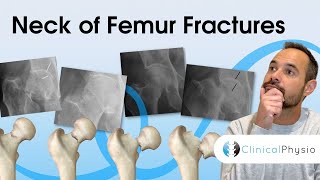 Neck of Femur Fractures  Expert Physio Review [upl. by Ylloj673]