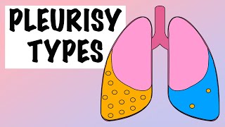 Difference between transudative and exudative pleural effusion [upl. by Nnalyrehc824]