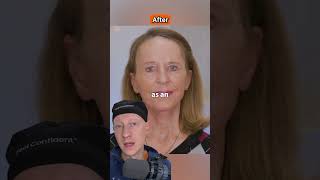 AMAZING Facelift amp Laser Resurfacing Transformation  Plastic Surgeon Reacts [upl. by Linnet]