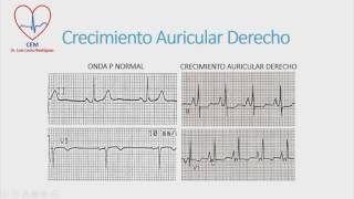 crecimientos auriculares [upl. by Nolham605]