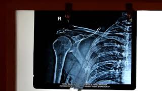 Radiological Anatomy of Upper limb [upl. by Ephraim]