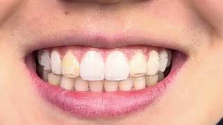 Invisalign Attachments on the Upper Lateral Incisors [upl. by Antonio]