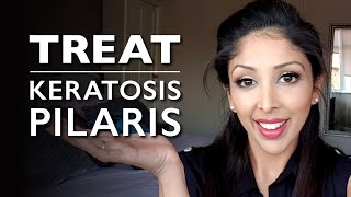 KERATOSIS PILARIS from DOCTOR V  KP Treatment chicken skin  How to treat KERATOSIS PILARIS  DR V [upl. by Odine]