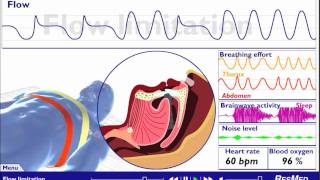 Understanding Sleep Disordered Breathing [upl. by Catlee331]