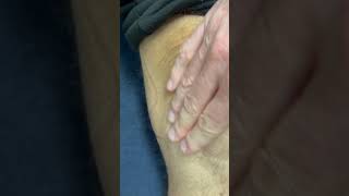 Fluid Bulging from Knee [upl. by Mungam]