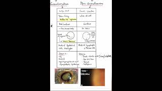 Granulomatous KPs vs Nongranulomatous KPs Shorts [upl. by Llenahc]