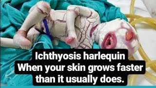 Harlequintype ichthyosis\ when your skin grows at a faster rate than it usually does [upl. by Holt121]