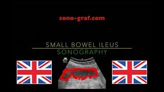 Sonography  Small Bowel Ileus [upl. by Missy]