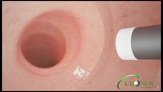 Revisão da Cirurgia Bariátrica do Tipo Bypass Via Gastroplastia Endoscopica [upl. by Rede]