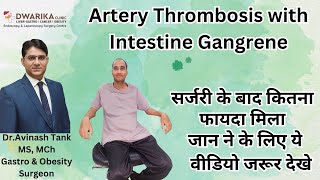 Artery Thrombosis with Intestine Gangrene Treatment by Dr Avinash Tank Dwarika Clinic Ahmedabad [upl. by Enial375]