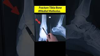 XRAY ANKLE JOINT  Fracture Tibia Bone  Fracture Medial Malleolus radiographerusn xray shorts [upl. by Salazar]