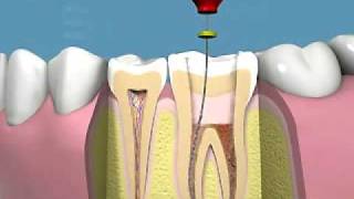 trattamento endodontico manuale e applicazione corona [upl. by Lowery]