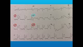 ECG interpretation STEMI vs NSTEMI [upl. by Donella]