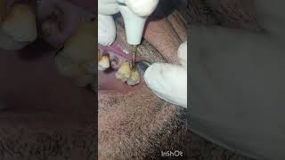 جير الاسنان ادى لانحسار اللثة  تنظيف  dentist stitch [upl. by Alan]