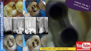 finding MB2 canal ultrasonic tip one curve micromega one visit endodontic treatment [upl. by Annaxor]