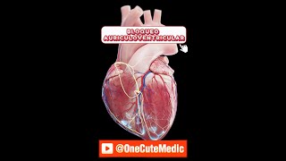 BLOQUEO AURÍCULOVENTRICULAR  MOBITZ I y II  OneCuteMedic [upl. by Pergrim382]