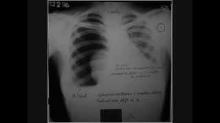 Hydropneumothorax  Lung collapse  role of Homeopathy [upl. by Nisay]