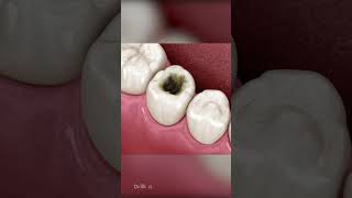 Composite Dental Fillings ASMR [upl. by Delaine]