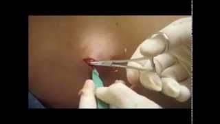 Cyst Removal NYC  212 6449494  NYC Cyst Removal  New York NY [upl. by Wolfgang]