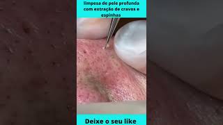 😃 limpeza de pele profunda com extração de cravos e espinhas  cravos e espinhas 😃😉 [upl. by Filberto]