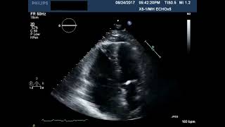 Hyperkinesis of right ventricular apex and hypokinesis of the right ventricular free wall [upl. by Sanborn850]