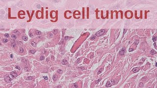 Leydig Cell Tumours of the Testis  Pathology mini tutorial [upl. by Scherman]