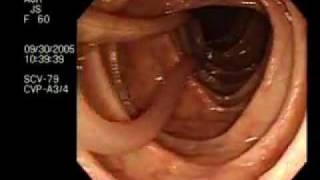 Worm Intestine Ascariasis [upl. by Alemap]