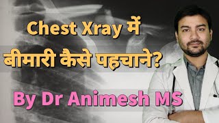 Chest Xray of Lung disease explained in hindi by DrAnimesh MS dranimesh surgeryonline pneumonia [upl. by Bronwyn]