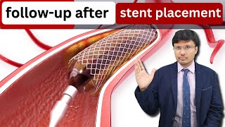 ANGIOGRAPHY LONG TERM FOLLOW UPfollowup after stent placement [upl. by Cirdek856]