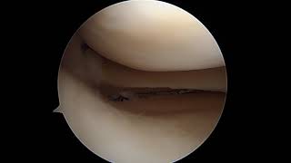 Knee Arthroscopy Medial Meniscal Root Repair [upl. by Rew]