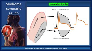 Electrocardiograma isquemia lesión necrosis y criterios de Sgarbossa [upl. by Blus]