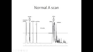 Ophthalmic Ultrasound Part 1 [upl. by Lede]