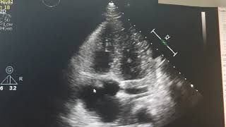 Infectious endocarditis Echocardiography [upl. by Cilurzo]